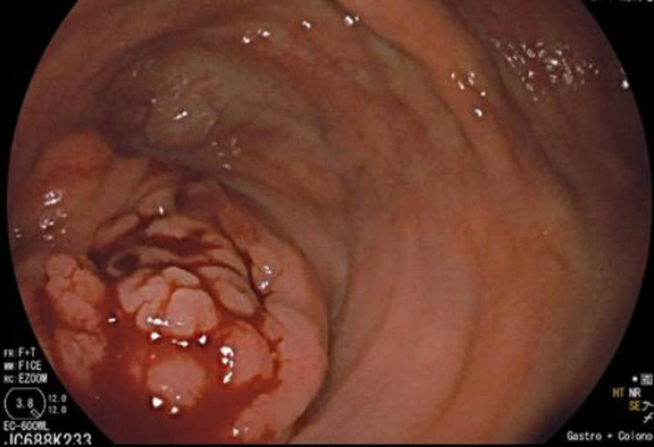 Irregular lobulated surface with distortion of the local anatomy