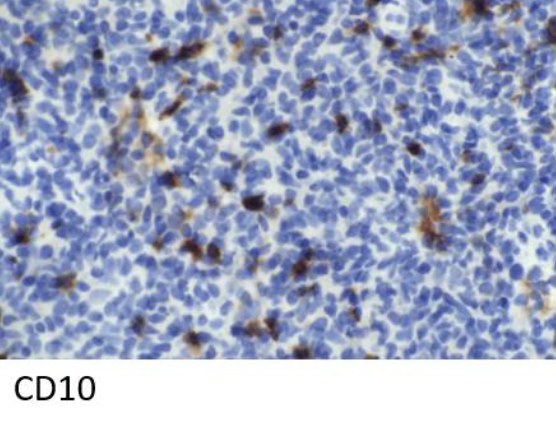 CD10 immunohistochemistry