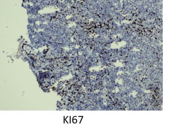 Ki-67 immunohistochemistry