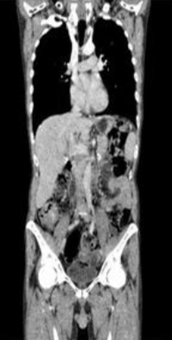 Coronal CT from the baseline staging PET/CT plate