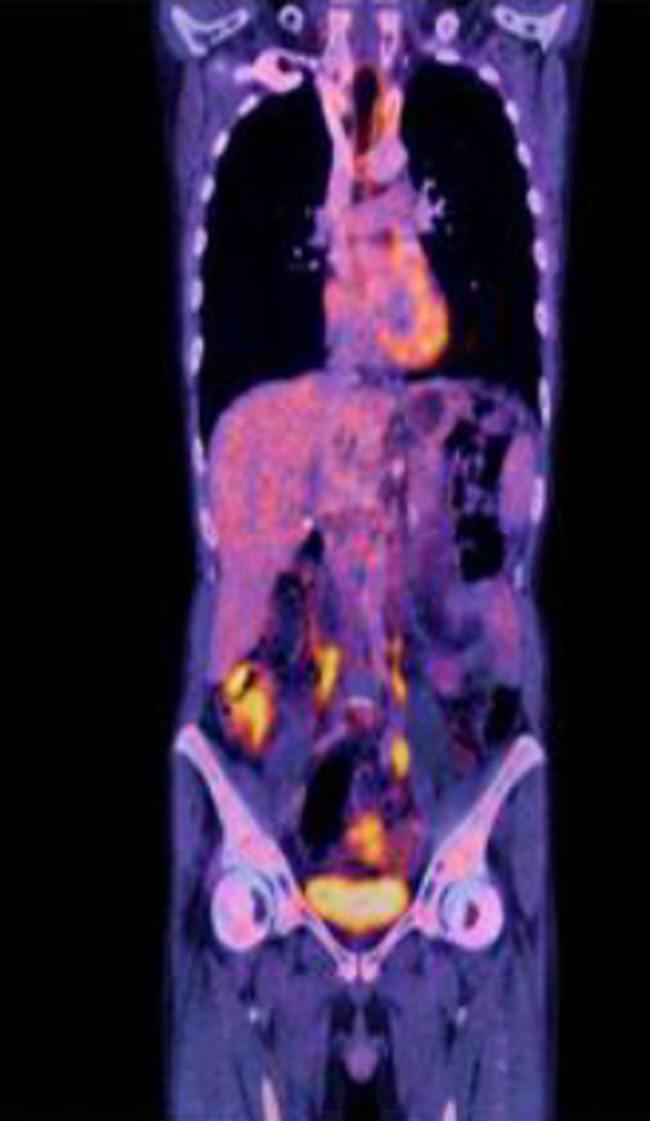 Coronal fused PET/CT from the baseline staging plate