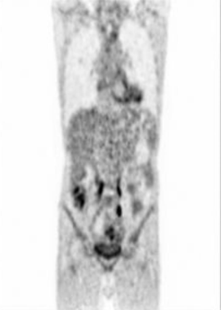 Coronal PET from the baseline staging PET/CT plate